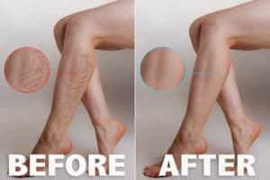Sclerotherapy Before and After Image