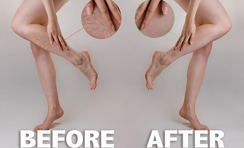Sclerotherapy Treatment Before and After Image